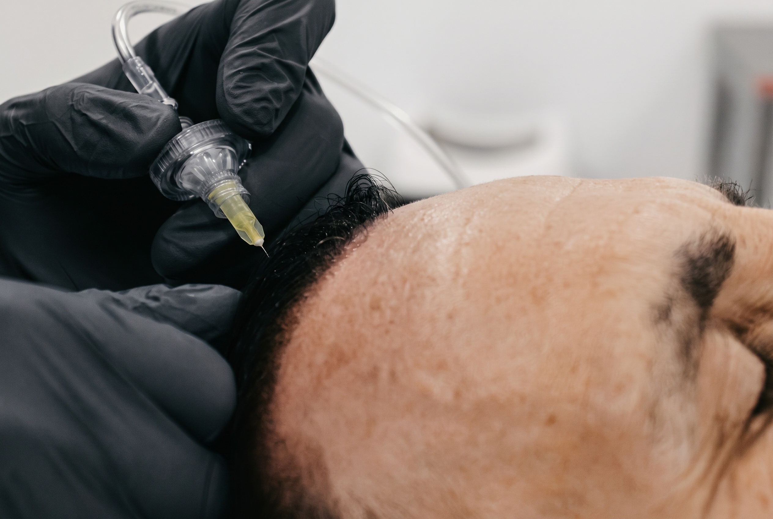 Aplicación de carboxiterapia en la línea frontal del cuero cabelludo