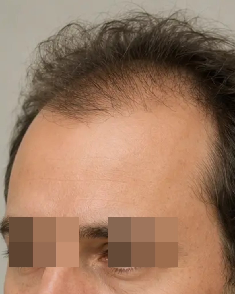 Línea frontal con retroceso antes de transplante capilar
